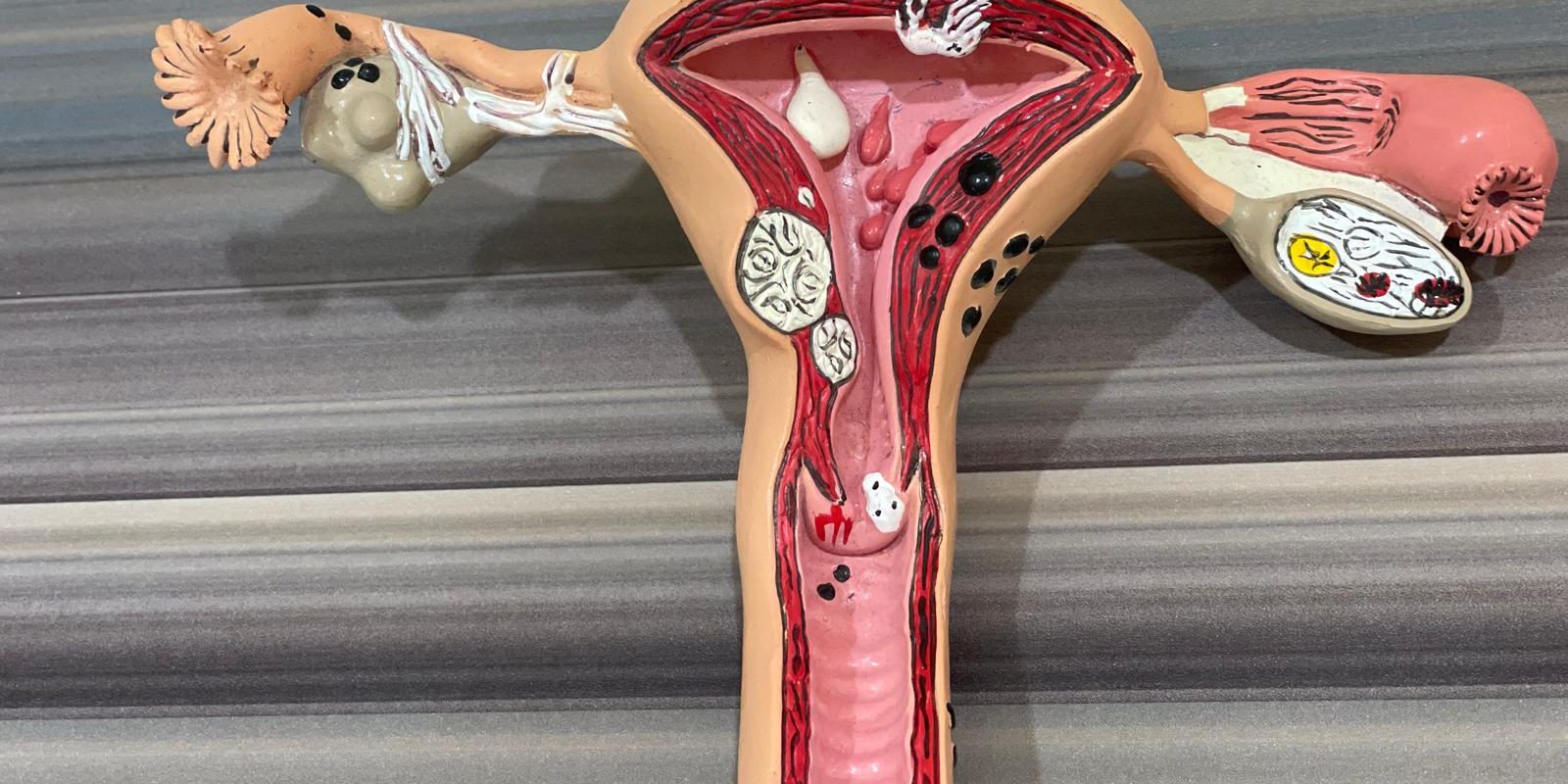 Fibromatoza Uterină
